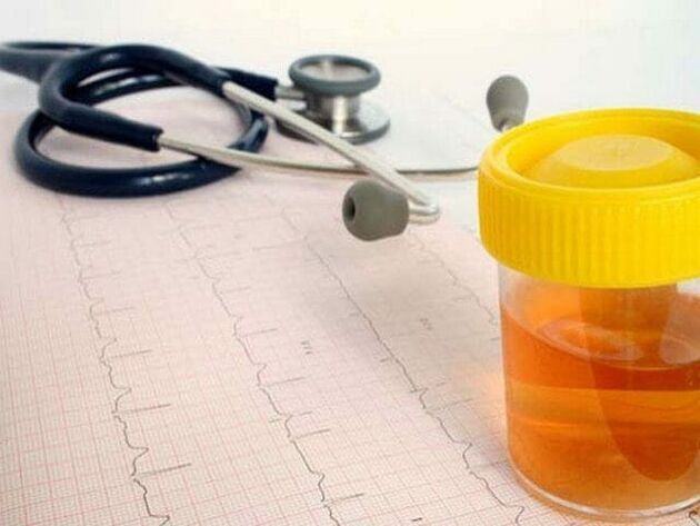 анализ на урината за диагностициране на цистит